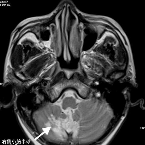 房颤治疗新进展，中成药研究与应用综述